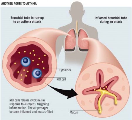 Asthma Attack Symptoms