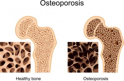 Osteoporosis Natural Treatment